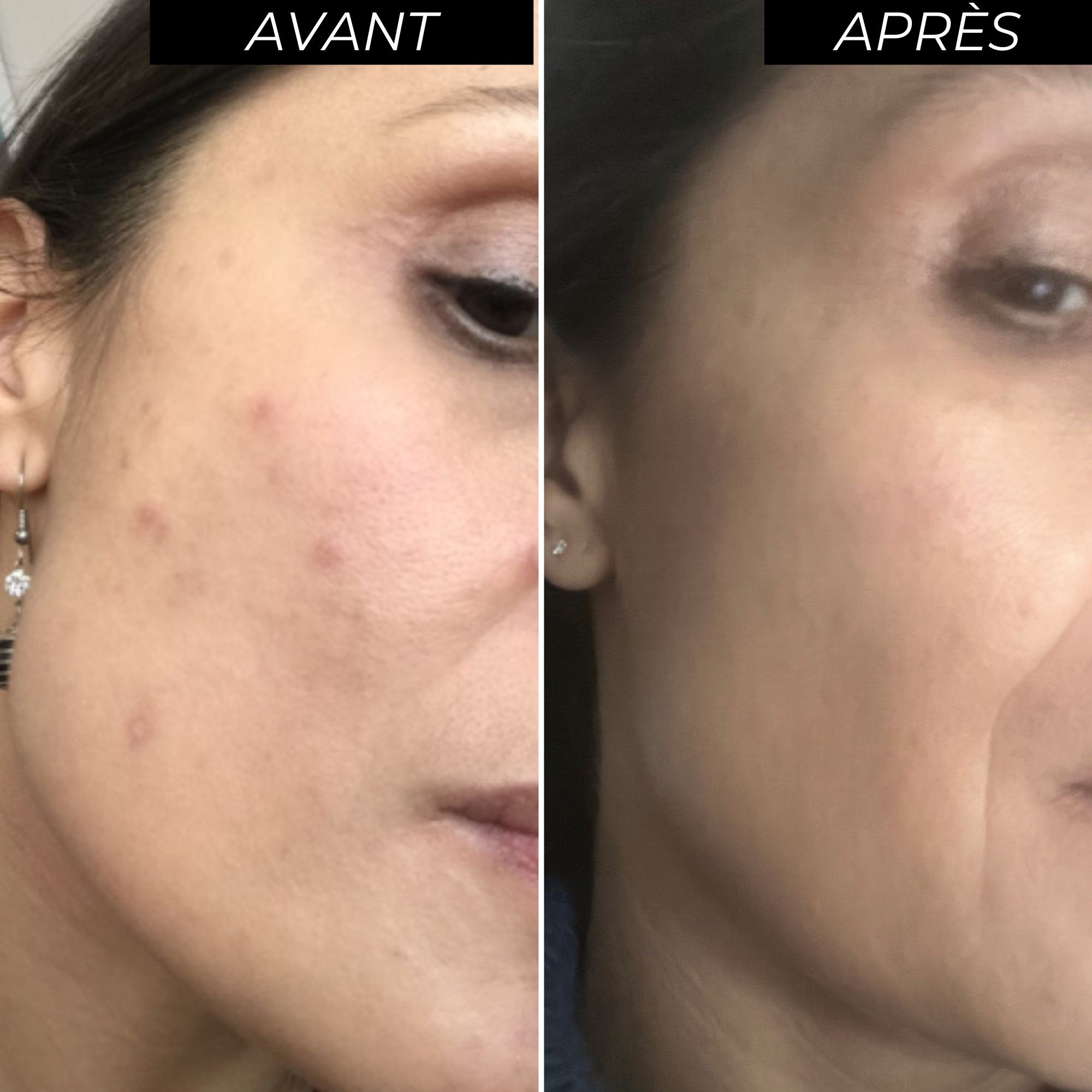 Avant/après protocole éclat du teint ENO-Image3